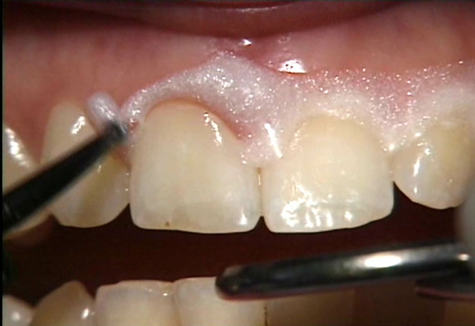 Rụng răng vì thuốc tẩy trắng răng